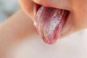 Candida als weißer Belag auf der Zunge